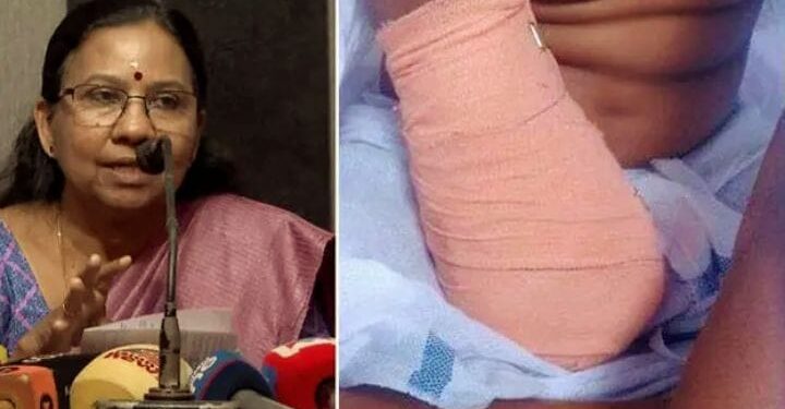 ഒമ്ബത് വയസുകാരിയുടെ കൈ മുറിച്ചുമാറ്റിയ സംഭവം: ചികിത്സാ പിഴവില്ലെന്ന് ആശുപത്രി സൂപ്രണ്ട്