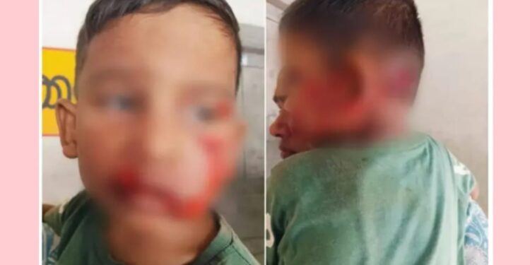 നാലുവയസുകാരന്റെ മുഖം കടിച്ചുകീറി തെരുവുനായക്കൂട്ടം